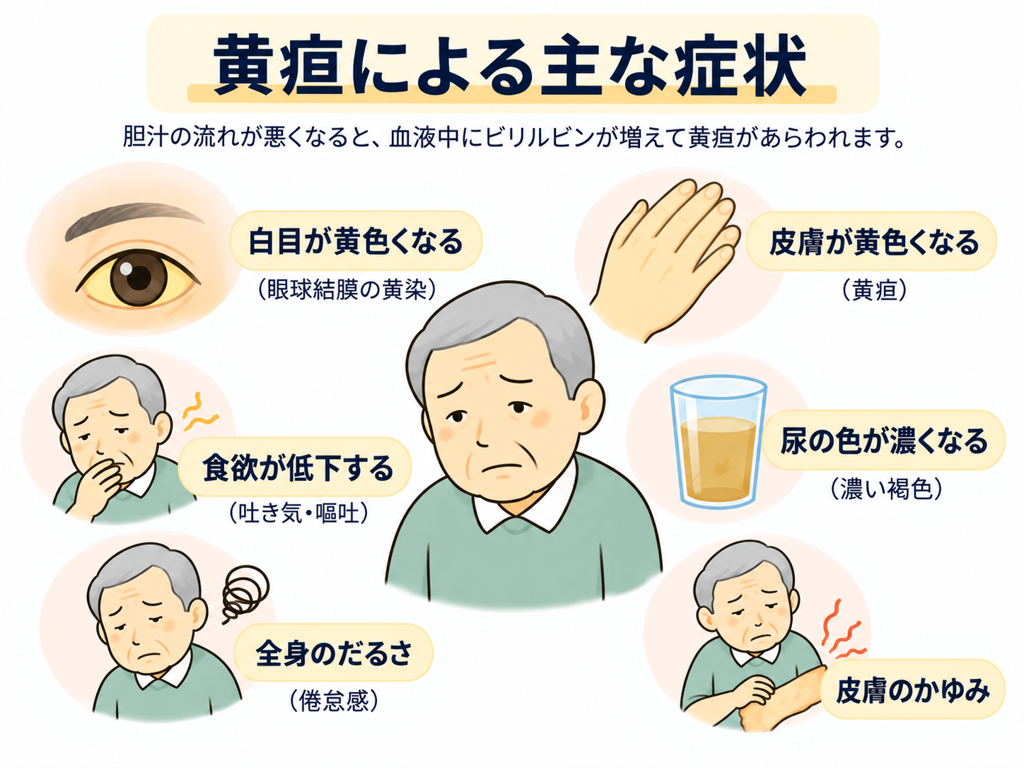 黄疸の主な症状のイラスト